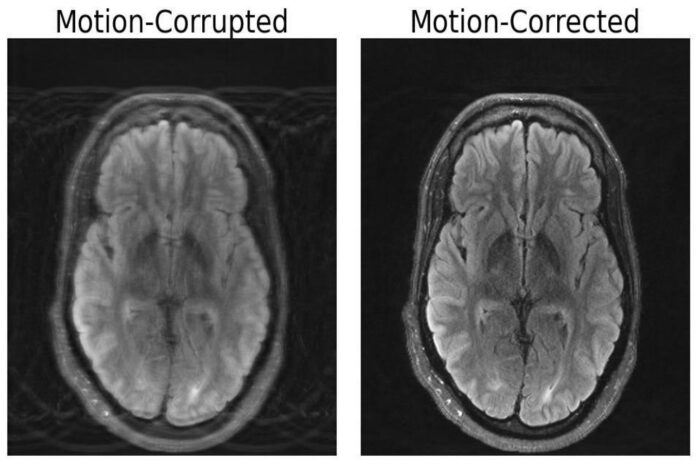 MIT researchers combine deep learning and physics to fix motion-corrupted MRI scans | MIT News